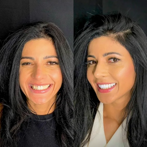 Juliana, antes e depois das lentes de contato dental